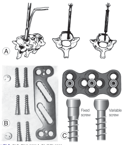 Diagram of the plate and screws used to fuse the bones from the front of the neck, and the direction in which the screws are inserted