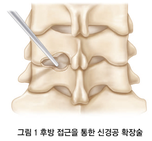 Cervical Surgery