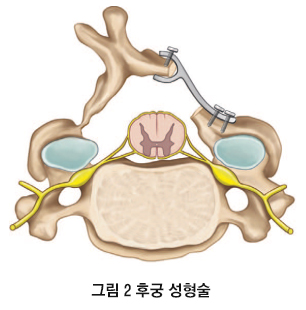 Cervical Surgery