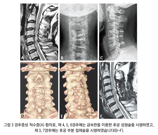 Cervical Surgery