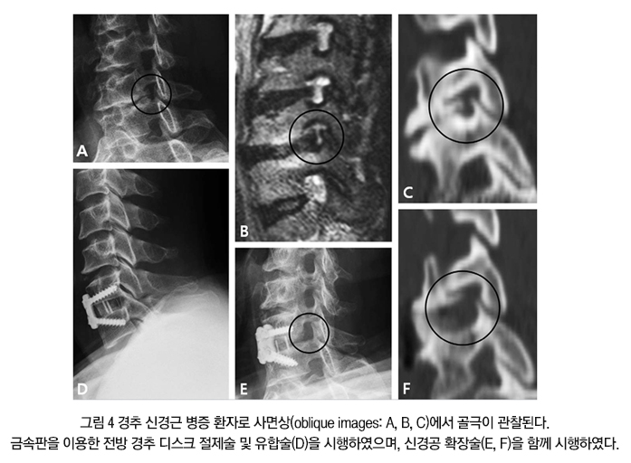 Cervical Surgery