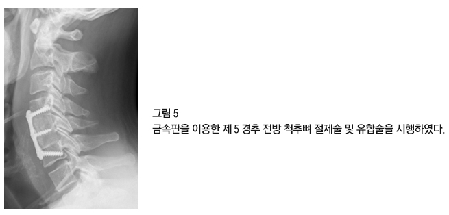 Cervical Surgery