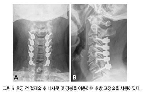 Cervical Surgery