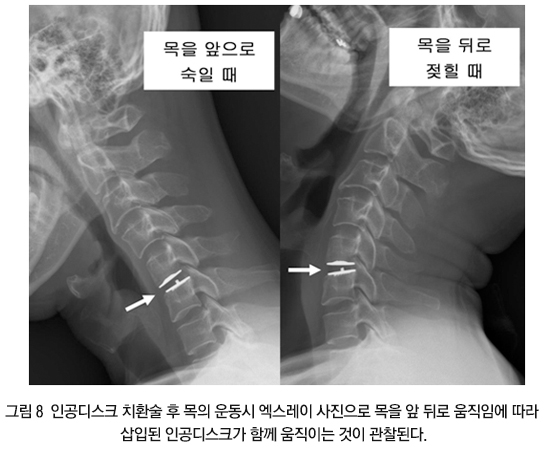 Cervical Surgery