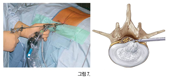 경추간공 접근법(Transforaminal approach) 수술 장면과 접근 경로 모식도