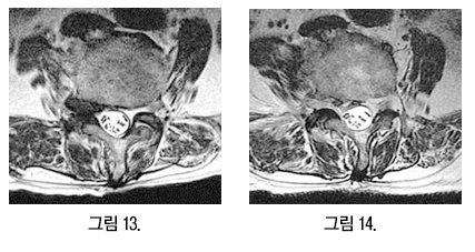 수술 전 MRI(그림13)와 수술 후 MRI(그림14) — 탈출됐던 수핵이 완전히 제거된 모습