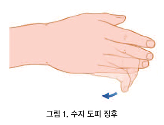 경추 척수증