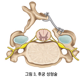 경추 척수증