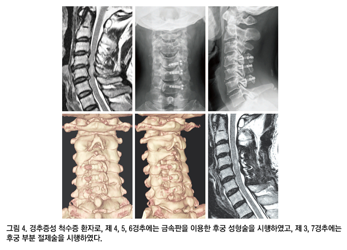 경추 척수증