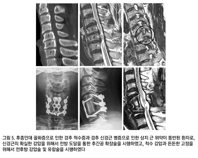 경추 척수증