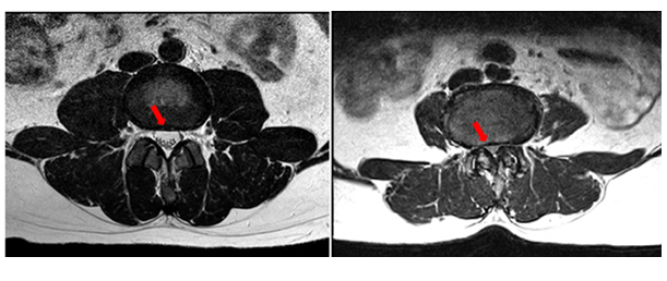 Spinal Stenosis