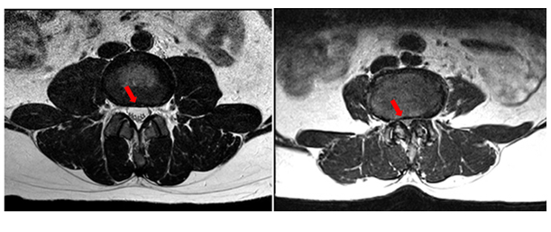 Spinal Stenosis