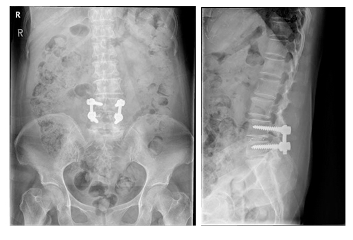 Spinal Stenosis